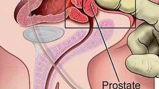 Náhledový obrázek - Rakoviny prostaty u českých mužů přibývá, zároveň klesá úmrtnost