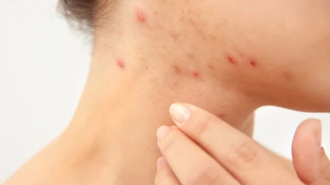 dermatitida