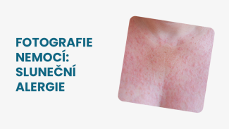 Náhledový obrázek - Sluneční alergie foto: projevuje se vyrážkou. Většinou ji doprovází i svědění