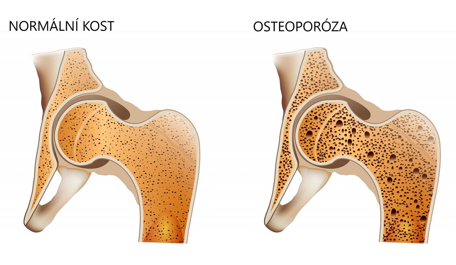 Srovnání zdravé kosti a kosti řídnoucí kvůli osteoporóze