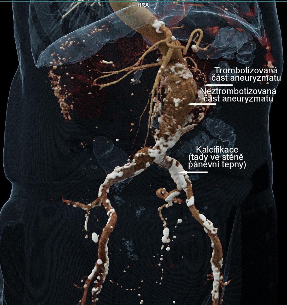 Na snímku břicha je zachycena výduť (aneurysma) břišní aorty, ukládání vápníku ve stěně srdečnice (kalcifikace ve stěně aorty) a pánevních tepnách.