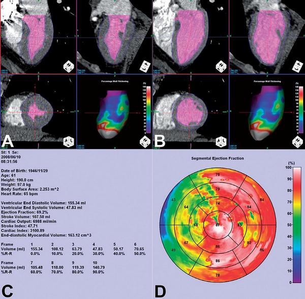 Obr. 10 – Hodnocení funkčních parametrů levé komory. A) Segmentace vnitřní a zevní kontury v systole. B) Segmentace v diastole. C) Tabulka s hodnotami objemů a dalšími vypočtenými parametry. D) Grafické znázornění podílů jednotlivých segmentů stěny na ejekční frakci.