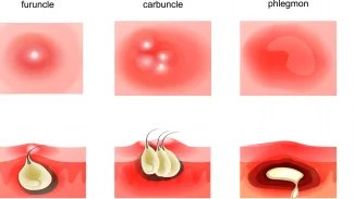 Karbunkly a furunkly jsou kožní abscesy. Flegmóna (phlegmona) je neohraničený bakteriální zánět šířící se měkkými tkáněmi, zvaný také celulitis. Je to hnisavé prosáknutí tkáně.
