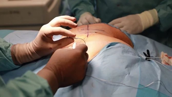Zavedení neurostimulátoru pro léčbu inkontinence