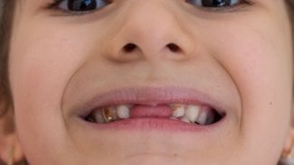 Náhledový obrázek - Skvrny na zubech mohou vzniknout i v důsledku určitých léků. Obvykle se jich dá zbavit