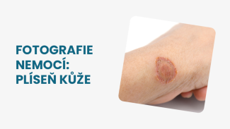 Náhledový obrázek - Plíseň kůže foto: příznaky bývají u všech typů dosti podobné. Obvykle se od sebe liší místem výskytu
