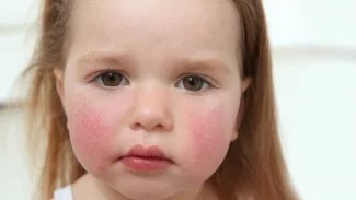 Náhledový obrázek - Příznaky páté nemoci se rozvíjí postupně. Typická je hlavně vyrážka na obličeji, trupu a končetinách