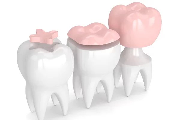 Inlay, overlay a korunka. Materiál u nich může být stejný, rozdíl je v tom, jakou část zubu nahrazují.