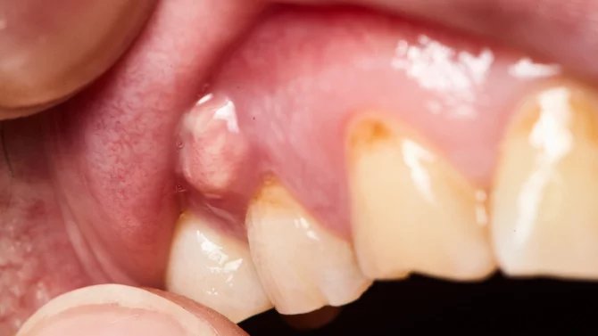 Paradontální absces – absces zubu nebo absces na dásni