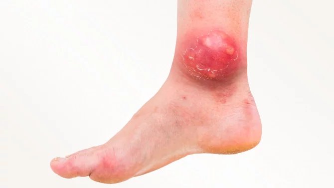 Abscesy mohou dosahovat různých rozměrů. Příznaky se významně liší podle toho, kde se nachází. Nejúčinnější a nejvyužívanější léčebnou metodou je u hnisavých ložisek vypuštění hnisu. Pokud se absces nachází blízko povrchu kůže, stačí naříznout jeho povrch a hnis vypustit. Poté se dutina proplachuje, aby se odstranily všechny rozpadlé tkáně, a zabránilo se tím rozvoji dalšího zánětu.