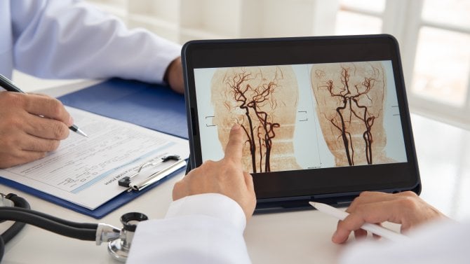 mozková mrtvice cévní mozková příhoda