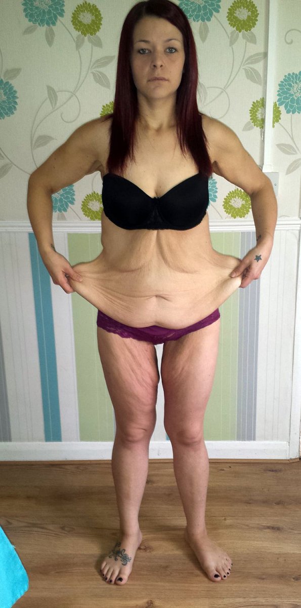 Napřed velká nadváha a pak rychle kila dolů s pomocí šílené diety a prášků. Výsledek? Ztráta 57 kg (ze 120 kg) a postava znetvořená velkým množstvím volné kůže.