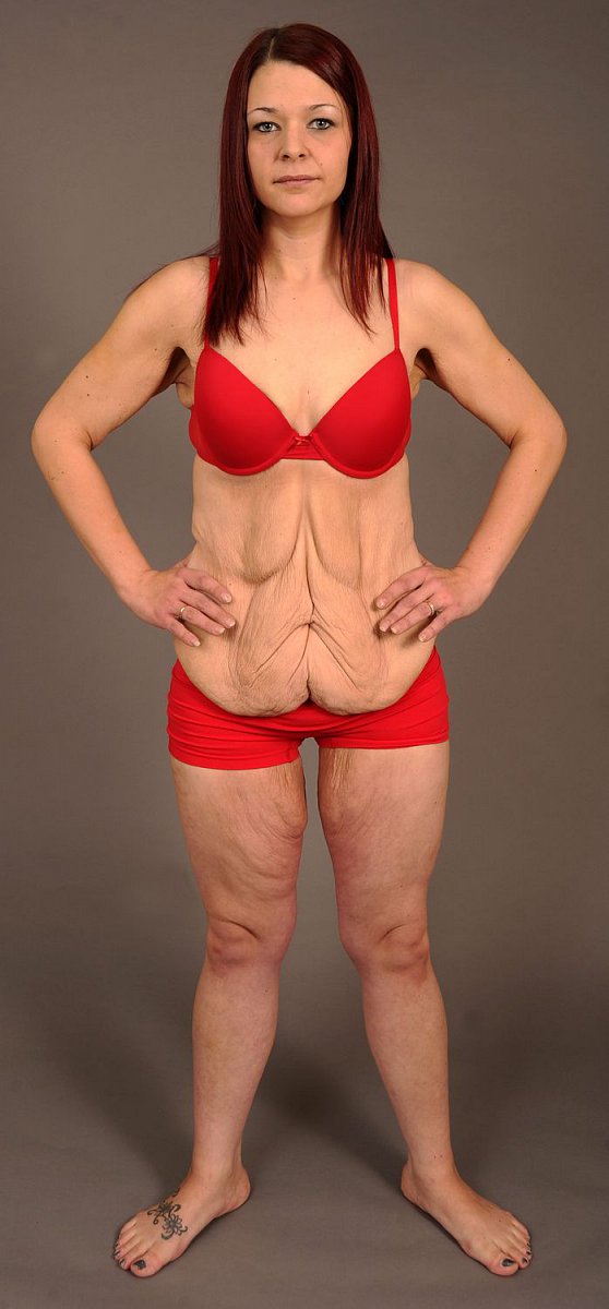 Napřed velká nadváha a pak rychle kila dolů s pomocí šílené diety a prášků. Výsledek? Ztráta 57 kg (ze 120 kg) a postava znetvořená velkým množstvím volné kůže.