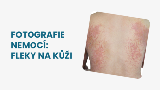 Náhledový obrázek - Fleky na kůži fotografie: porovnání různých typů kožních problémů a popis jejich charakteristických rysů