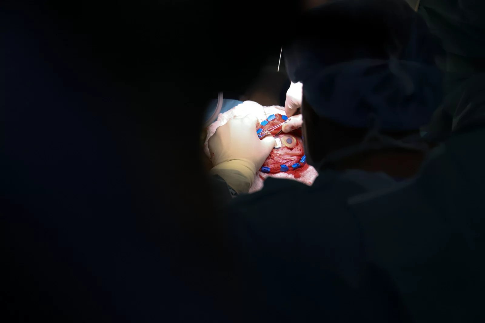 Cívku a elektromagnet lékaři zabrousili a ukotvili do lebeční kosti. Pacient jej ve finále má skryt pod kůží.