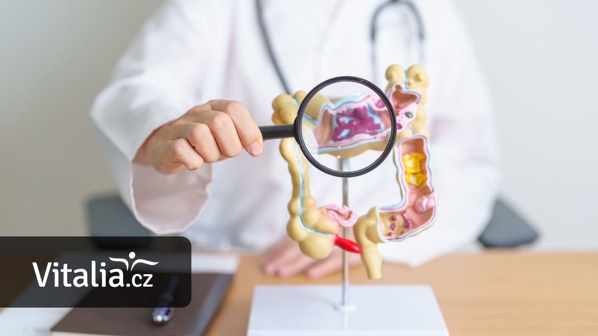 Změna pravidel kvůli rakovině. Na preventivní koloskopii by měli lidé chodit už ve 45