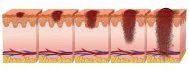 U melanomu kůže se objevují dvě fáze růstu. V první fázi roste v zevní vrstvě pokožky v radiálním směru, časem ale postupuje do vertikální fáze, kdy maligní buňky zasahují spodní vrstvu kůže a získávají schopnost metastazovat.