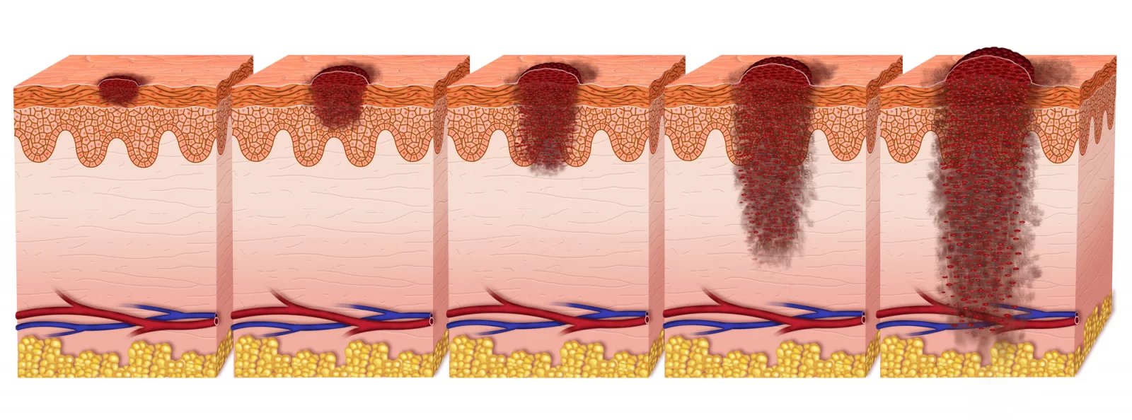 U melanomu kůže se objevují dvě fáze růstu. V první fázi roste v zevní vrstvě pokožky v radiálním směru, časem ale postupuje do vertikální fáze, kdy maligní buňky zasahují spodní vrstvu kůže a získávají schopnost metastazovat.