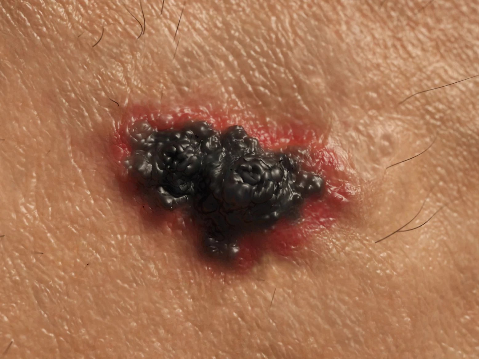 Melanom má většinou nepravidelné okraje a nejednotnou barvu. Většina melanomů má hnědou nebo černou barvu, ale mohou se objevit také jeho růžové, červené nebo fialové formy.