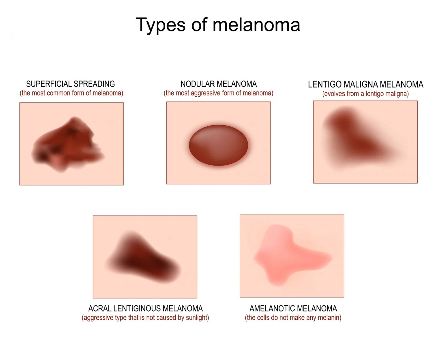 Podle způsobu růstu a stupně progrese pak lékaři rozlišují několik typů melanomů.