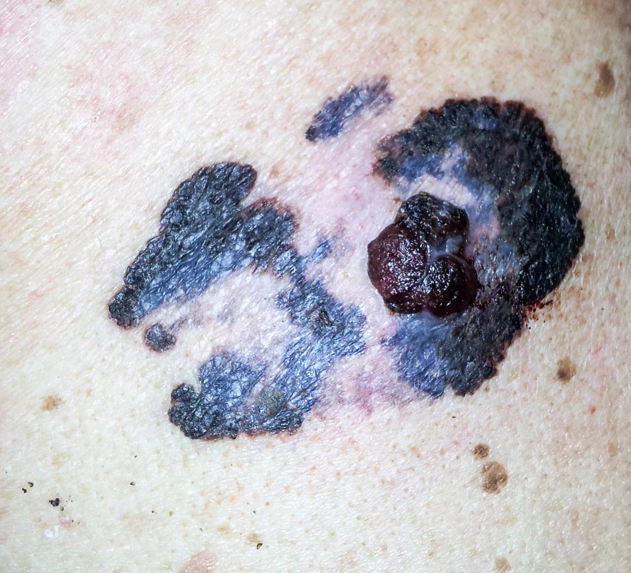 Charakteristickým znakem pro kožní melanom je pak nepravidelný tvar a ohraničení. Každá jeho polovina vypadá jinak a okraje jsou vroubkované. Kromě toho je pro něj obvyklé nerovnoměrné rozložení barev a někdy je také vícebarevný, nebo naopak bezbarvý.