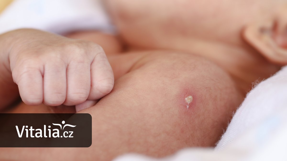 Plošné očkování proti tuberkulóze není třeba. Vzniká ale vakcína bez jizvičky na paži