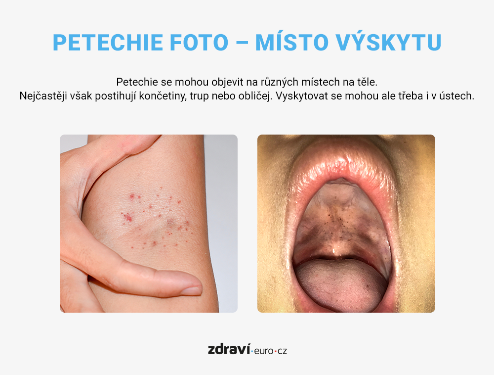 Petechie foto