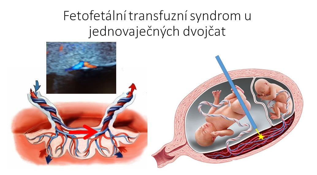 Jak probíhá záchrana nenarozených dětí?