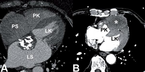 Obr. 16 – Nádory srdce a perikardu. A) Myxom levé síně nasedající široce na mezisíňové septum. Výrazné kalcifikace v tumoru. B) Lokální metastáza při recidivě karcinomu thymu nasedá na ventrální stranu srdce, především na výtokový trakt pravé komory. Komprese ramus interventricularis anterior (šipka). Levá komora (LK), levá síň (LS), pravá komora (PK), pravá síň (PS).