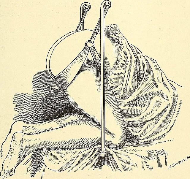 Z učebnice moderní gynekologie, rok 1906