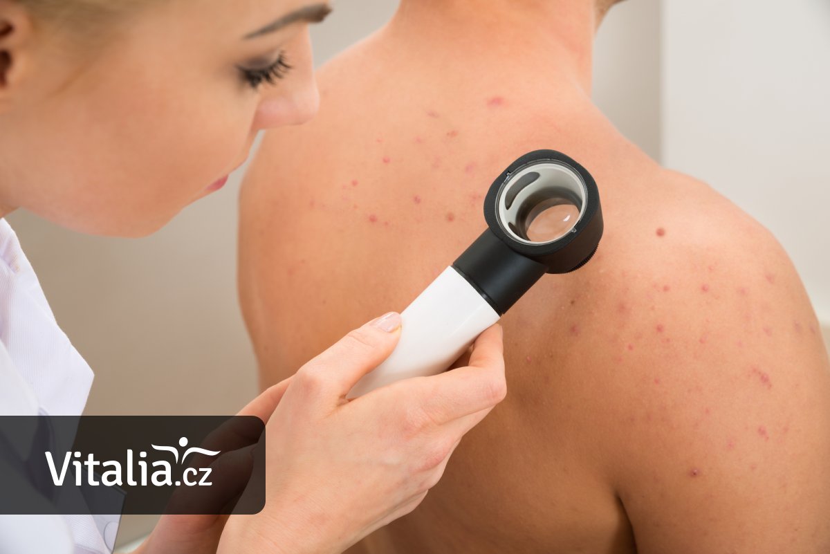 Díky aplikaci, kterou platí pojišťovna, se za tři měsíce povedlo objevit devět melanomů