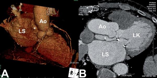 Obr. 15 – Pseudoaneuryzma po anuloplastice mitrální chlopně způsobené následně chirurgicky verifikovaným drobným defektem ve výtokovém traktu levé komory (LK). Pseudoaneuryzma (*) je mezi aortou (Ao) a levou síní (LS). Schodovité artefakty na koronárních tepnách viditelné v 3D zobrazení jsou způsobeny nepravidelným rytmem při fibrilaci síní.