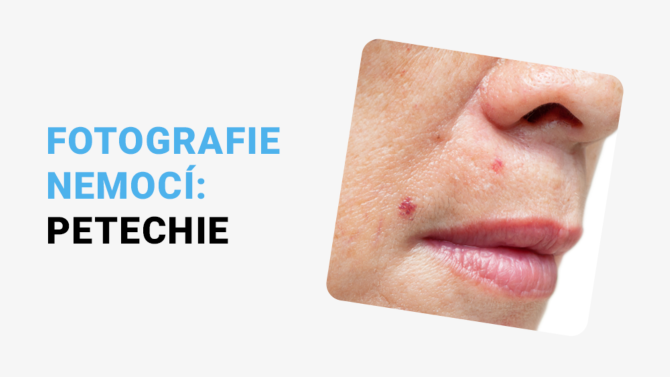 https://i.iinfo.cz/images/Petechie foto