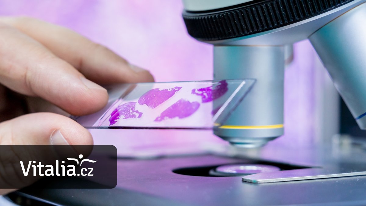 Ministerstvo chce omezit screening rakoviny čípku, má skončit preventivní cytologie mladých žen