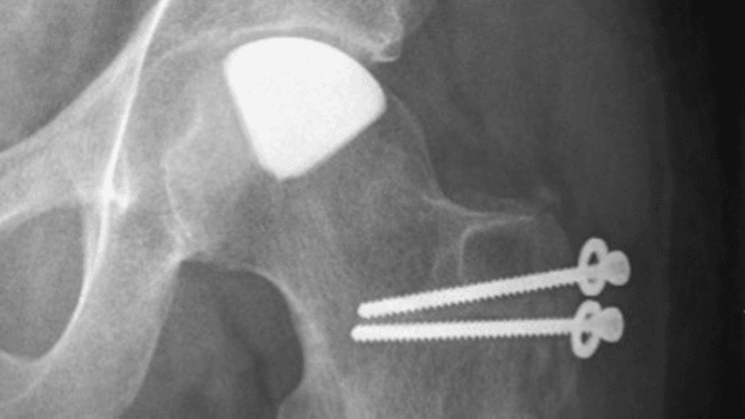 Rentgenový snímek zachycující nový typ implantátu při poškození kyčle
