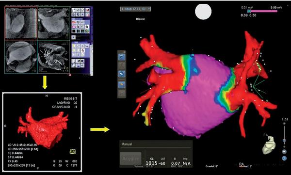 Obr. 3 – Princip zobrazení vysokorotační angiografií (Siemens Inc. – Dyna CT). Přes pigtail katétr zavedený v v plicní artérii se zobrazí kontrast v levé síni, který se snímá za ultrarychlé rotace, postupně se segmentuje na pracovní stanici Leonardo a takto získaný obraz levé síně je možné použít i k provádění katetrizační ablace s podporou systému CARTO.