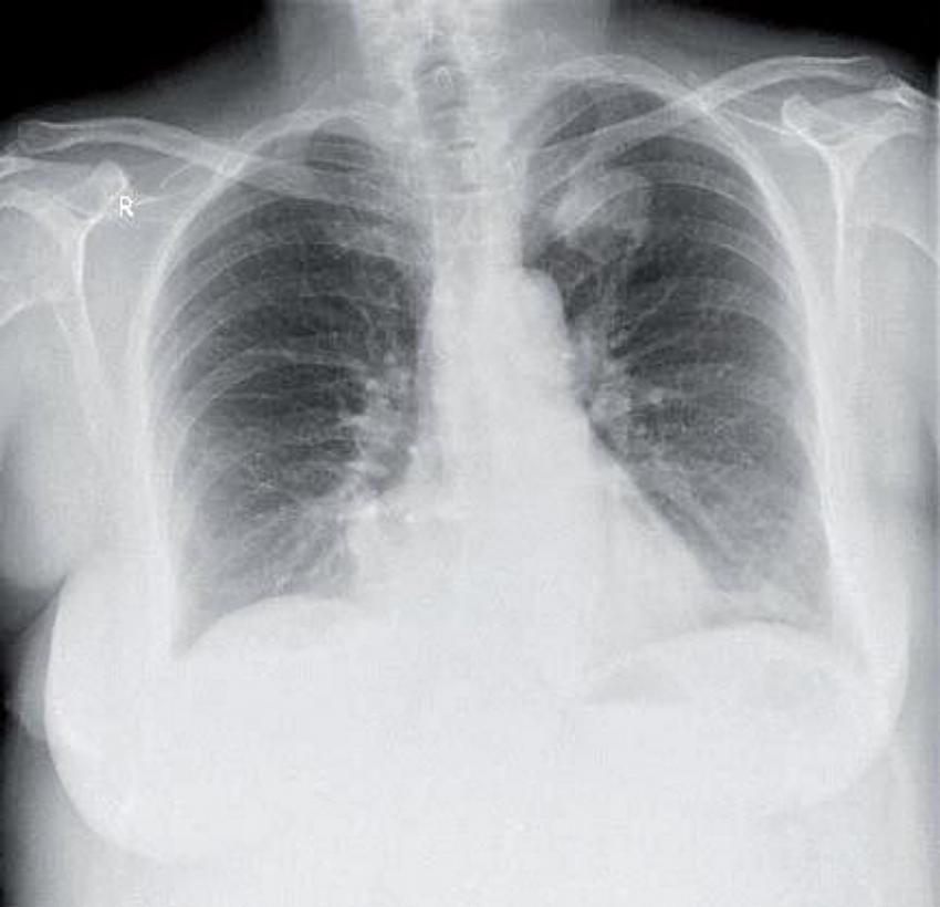 Obr. 1 – Dutinová formace v levém horním plicním laloku při postižení invazívní zygomykózou na zadopředním rtg snímku plic – z archívu Radiologické kliniky LF MU a FN Brno