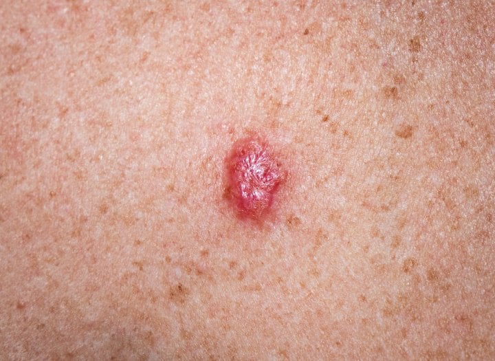 Bazaliom, anglicky basal cell carcinoma