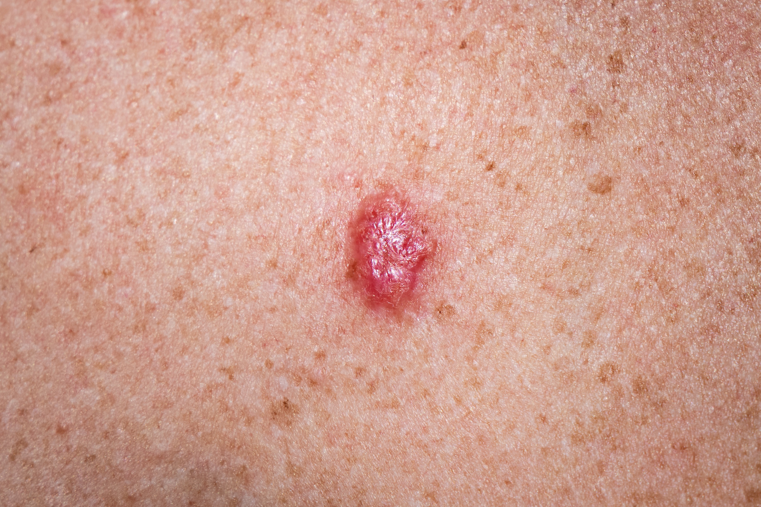 Bazaliom, anglicky basal cell carcinoma