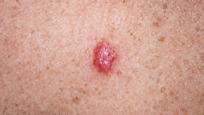 Bazaliom, anglicky basal cell carcinoma
