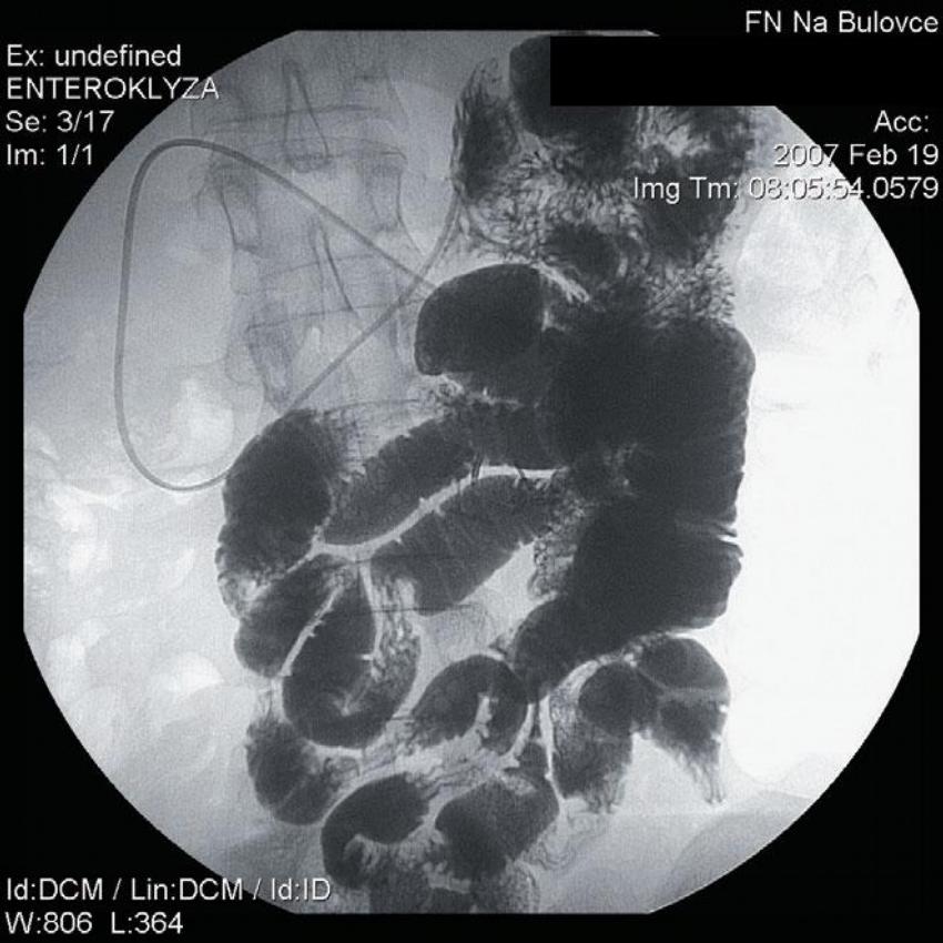 Obr. 5 – Enteroklýza po resekci, tenké střevo bez stenózy 2 roky po operaci