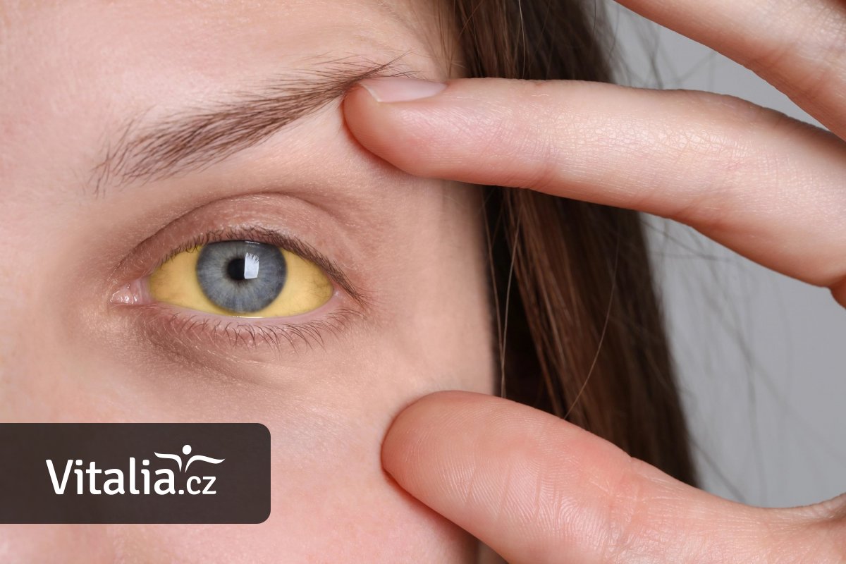 Přibývá čtyřicátníků se žloutenkou A, nemoc se šíří dotekem. Očkování na pojišťovnu hned tak nebude