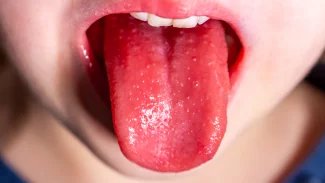 Náhledový obrázek - Příznaky spály zpočátku připomínají běžnou angínu. Následně se přidává zarudlá vyrážka
