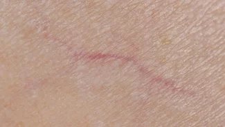 Náhledový obrázek - Metličkové žilky způsobuje dědičnost i nezdravá životospráva. Jak je odstranit?