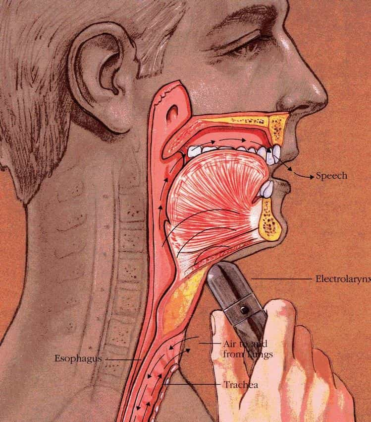 Elektrolarynx