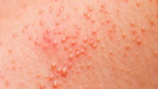 Náhledový obrázek - Potničky u dospělých způsobuje ucpání vývodů potních žláz. Nejčastěji se objevují kolem genitálií a pod prsy