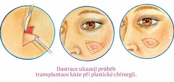 Ilustrace ukazují průběh transplantace kůže při plastické chirurgii.