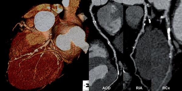 Obr. 6 – Difúzní výrazně kalcifikované aterosklerotické změny. Na RCx výrazná kalcifikace zcela znemožňuje hodnocení části lumen, v tomto úseku může být uzávěr, významná stenóza i nevýznamné změny. V případě tohoto pacienta však nehodnotitelnost části lumen neměnní výsledek CTKG, kterým jsou významné stenózy všech tří koronárních tepen. ACD – arteria coronaria dextra, RIA – ramus interventricularis anterior, RCx – ramus circumflexus