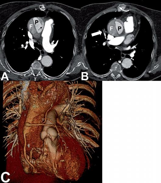 Obr. 23 – Pacientka s aortokoronárními bypassy a s novou atypickou bolestí na hrudi. Bylo provedeno vyšetření triple rule-out s cílem zobrazit jak systémové, tak plicní tepenné řečiště pro identifikaci příčiny bolesti. A) Jako nejpravděpodobnější hlavní příčina aktuální bolesti na hrudi byla určena disekce vzestupné aorty s entry na počátku oblouku aorty nad bypassy (šipka). B) Dalším – spíše vedlejším – nálezem byla solitární segmentární embolizace do plicní tepny segmentu středního laloku vpravo (šipka). C) Všechny tři bypassy byly v celém průběhu volně průchodné, proto koronární příčina bolestí byla stanovena jako nejméně pravděpodobná. P – pravé lumen aorty, F – falešné lumen.