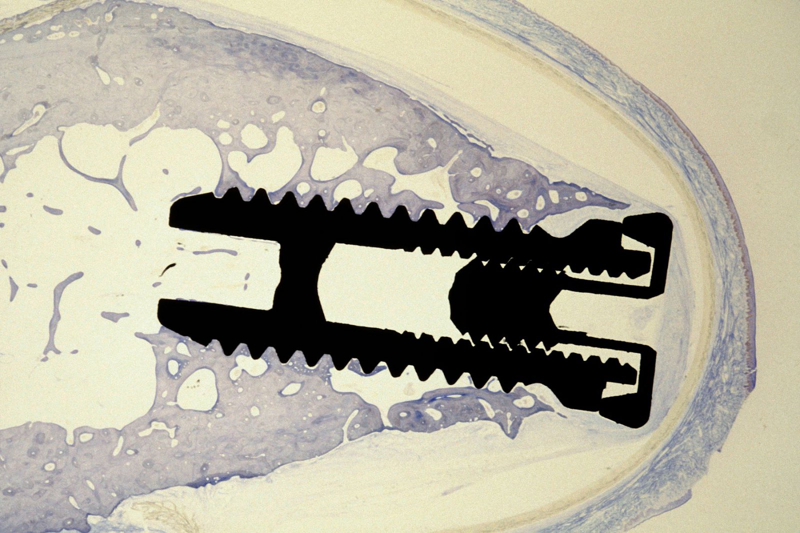 Zubní implantáty